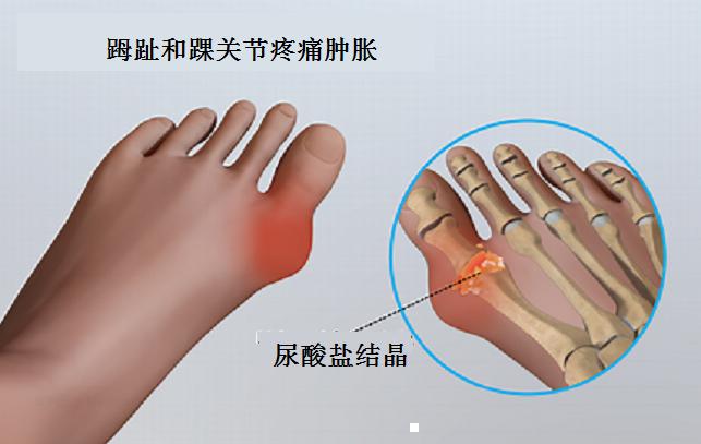痛风病人应该避免吃哪些食物?