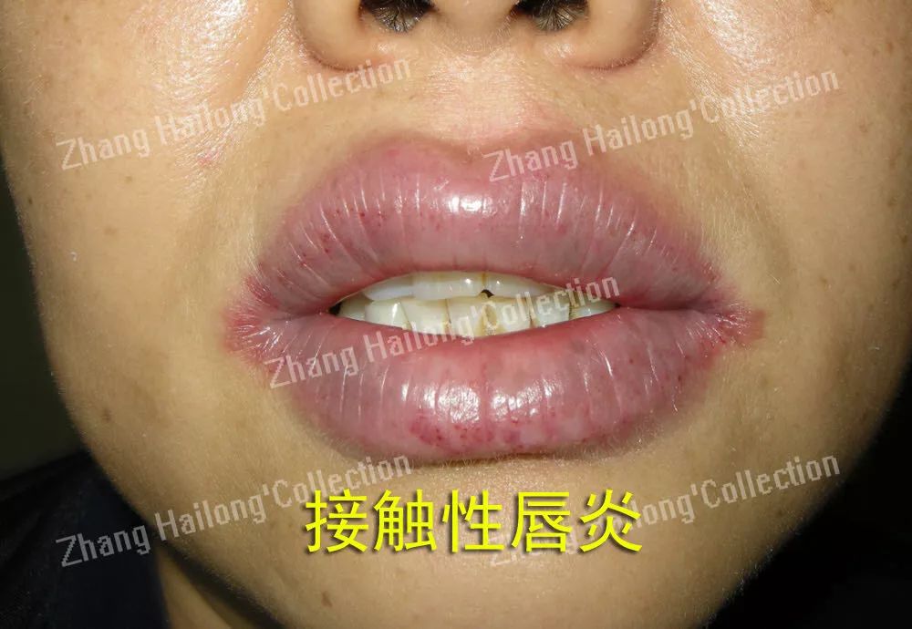 唇炎反复和口红有关系吗,都是红唇惹的祸