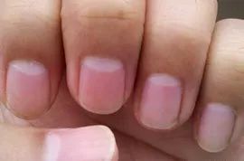 娃指甲上有白点是怎么回事,孩子指甲横纹有白点