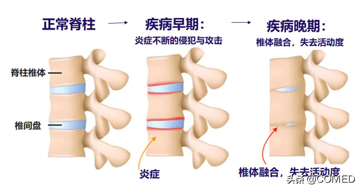 北京协和医院类风湿专家曾小峰,免疫科专家协和曾小峰