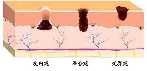 泪痣点痣后会倒霉是真的吗,泪痣点掉了要注意什么