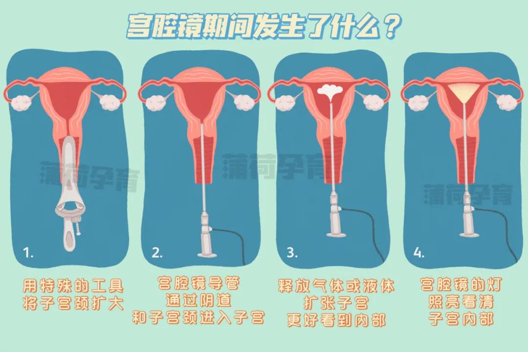 试管前做宫腔镜检查有利于着床吗,试管必做的检查