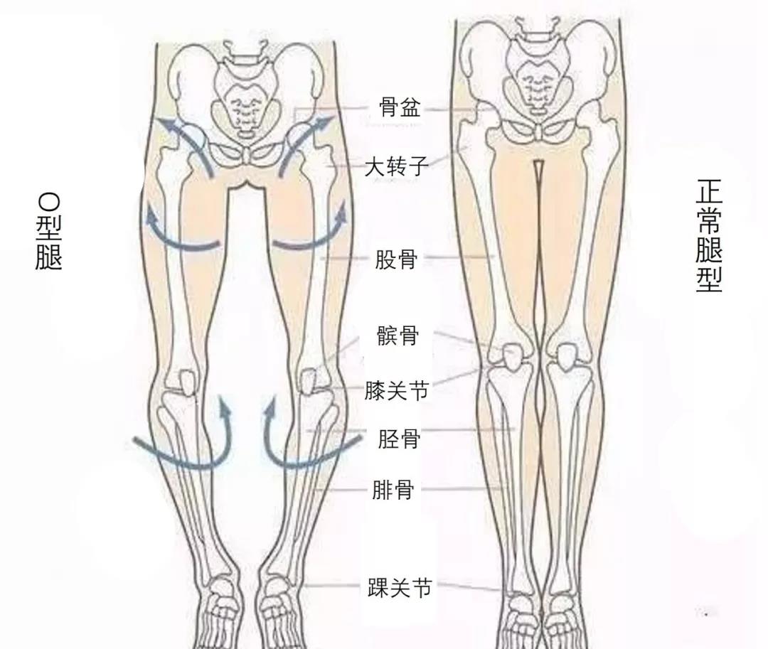 17岁xo型腿能矫正过来吗,x型腿o型腿能矫正吗