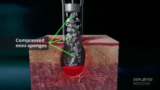 突破传统止血局限：美军战场止血利器X-stat