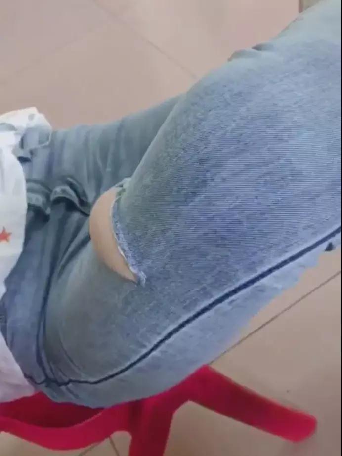 滑冰把膝盖内侧摔了怎么办,溜冰时膝盖磕破怎么办