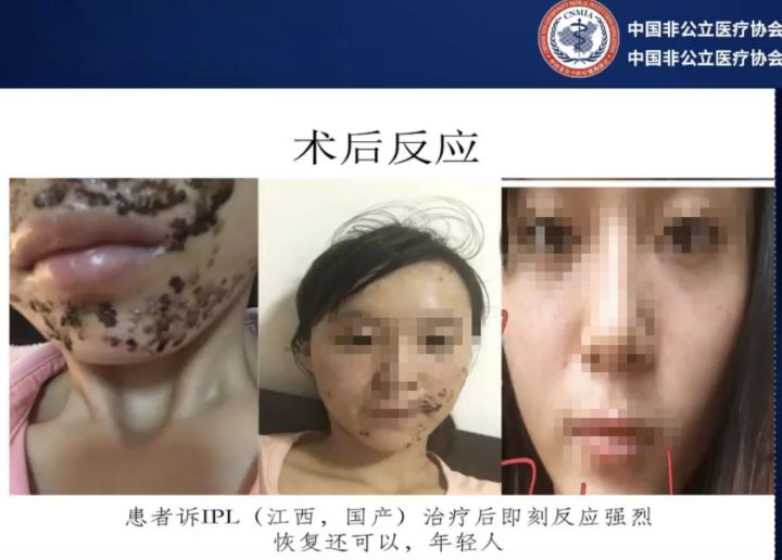 打完玻尿酸和瘦脸针的注意事项,打完玻尿酸和瘦脸针应该注意什么