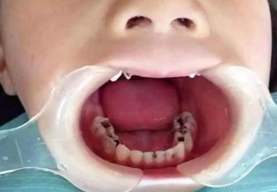四岁儿童有黑牙怎么办,3岁儿童满口小黑牙元凶并不是糖