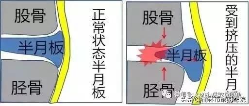 内侧半月板后角损伤怎么治疗,半月板损伤有积液的最好治疗