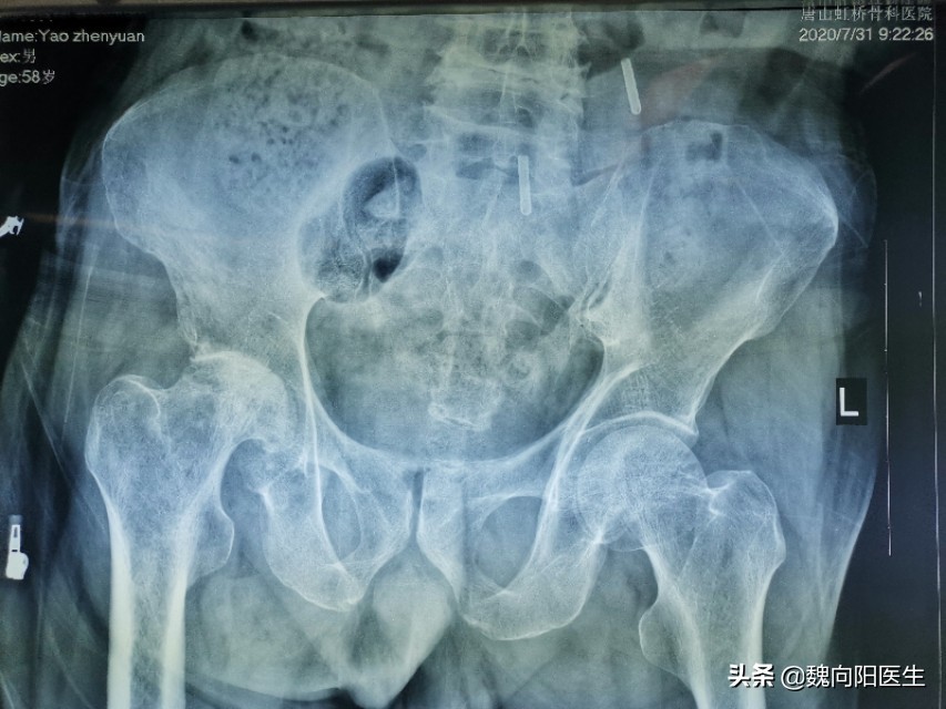 膝关节疼痛快一年了一直不敢蹲下,膝关节疼痛治疗期间反反复复