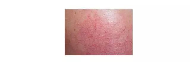 红血丝对颜值影响多大,天生红血丝泛红怎么修复