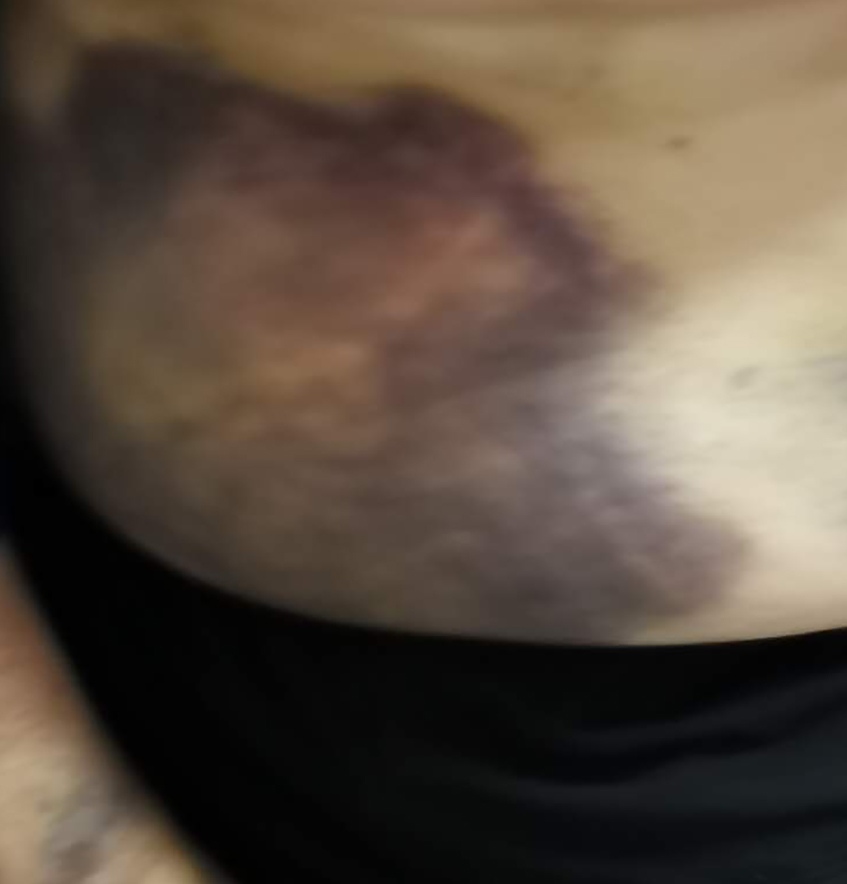 老人皮下出现淤血用药处理,卧床老人皮下出血是怎么回事