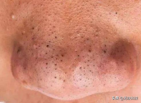 不管黑头的后果,不管黑头行吗