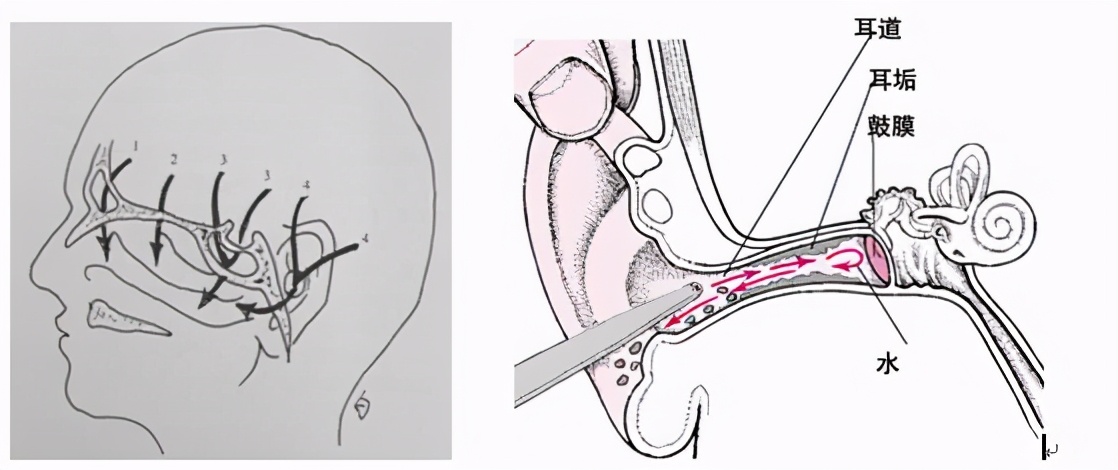 打喷嚏流鼻涕是脑脊液鼻漏吗,如何判断脑脊液鼻漏还是感冒