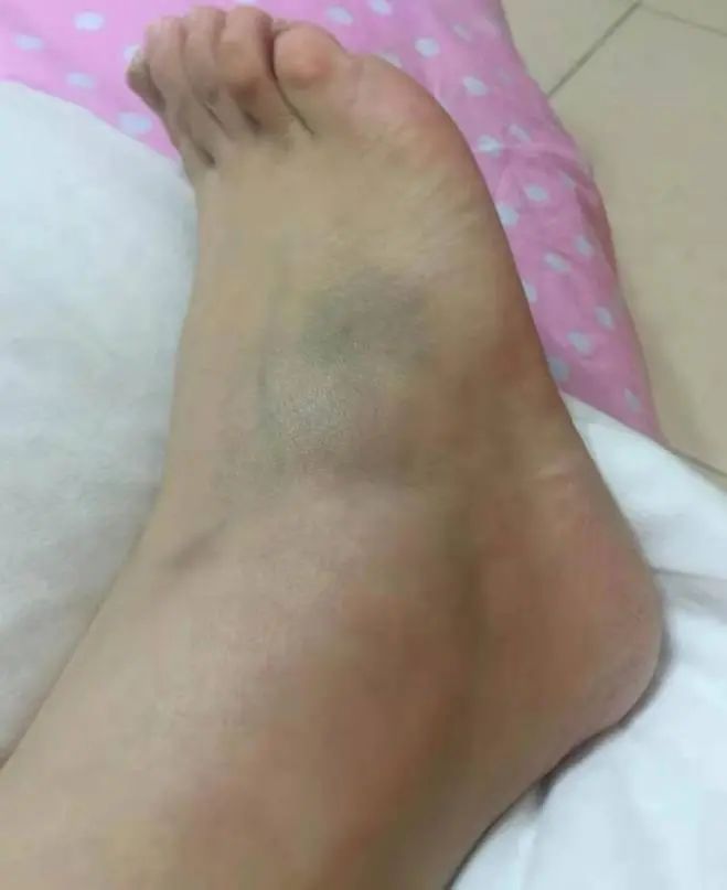 手麻肌电图检查过程视频,手麻脚麻肌电图正常