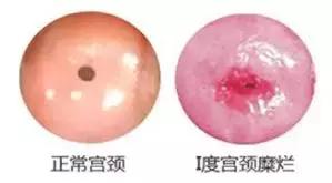 宫颈糜烂肥大囊肿会引起宫颈癌吗,宫颈肥大宫颈糜烂宫颈囊肿症状