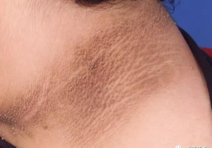 脖子黑黑的总是洗不掉怎么办,脖子上总是黑黑的怎么办