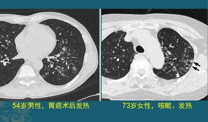 化脓性细菌感染用什么抗生素,化脓性细菌感染有痰用什么抗生素