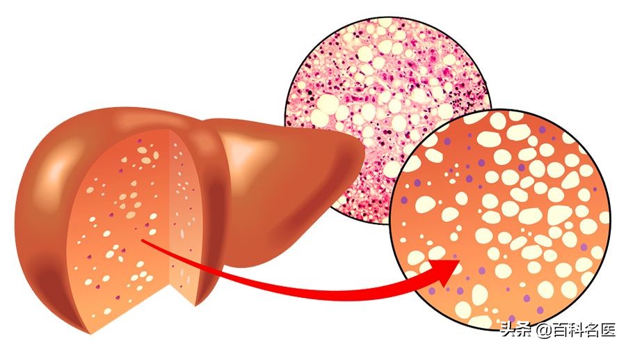 脂肪性肝炎需要注意什么,世界肝炎日肝炎你了解吗