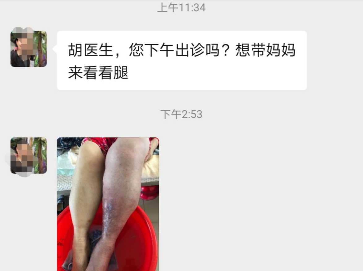 如何避免久坐导致的腿肿,女性长期久坐腿肿容易得什么病