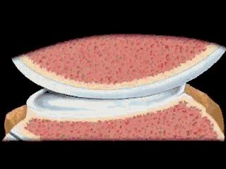 半月板撕裂要不要去修复,内侧半月板撕裂会切除多少半月板