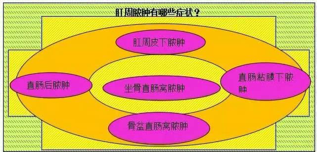 肛瘘和肛周脓肿症状区别,肛周脓肿的症状是肛瘘吗