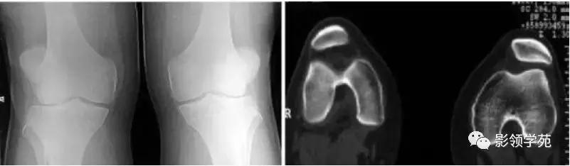 膝关节常见疼痛原因及其缓解方法,膝关节疼痛的16种最常见原因速查