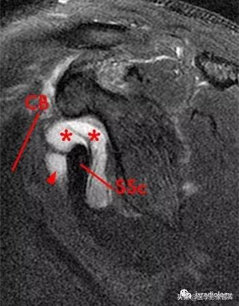 肩关节滑膜解剖,肩关节周围肌肉解剖
