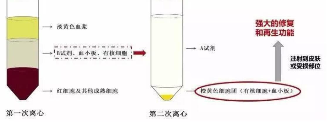 肉毒素和玻尿酸除皱哪个更实惠,如何选择肉毒素和玻尿酸注射除皱