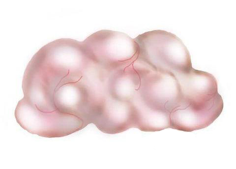 一年之内长了一个乳腺纤维瘤,胸里长纤维瘤用做手术吗