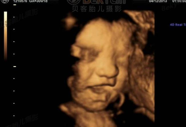 四维彩超准确么,四维彩超可以了解什么