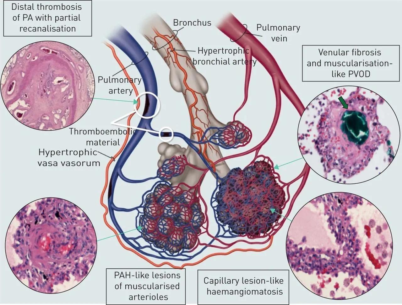 先天性心脏病主动脉与肺动脉,先天性心脏病肺动脉高压的表现