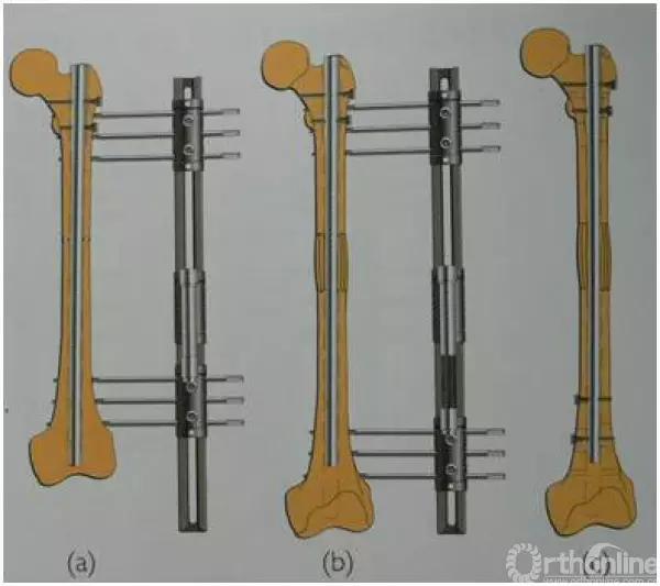 外固定支架训练方法,外固定支架拆除后怎么护理