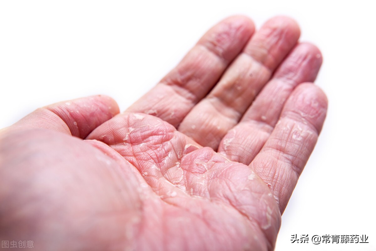 银屑病用药无效怎么办？医生：这7种药极为有效，但是副作用大