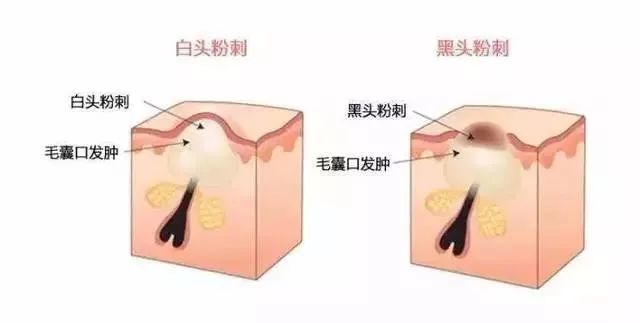 棰濆ご绮夊埡闂彛鎬庝箞鍘婚櫎,鍘婚櫎闂彛绮夊埡鐨勬姢鑲ゅ搧