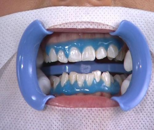 牙齿美白对牙齿有没有什么危害,牙齿美白脱色剂对牙齿有危害吗