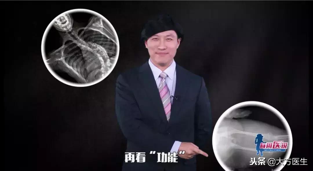 胸片没事排除肺病吗,胸片没事是不是可以排除肺炎