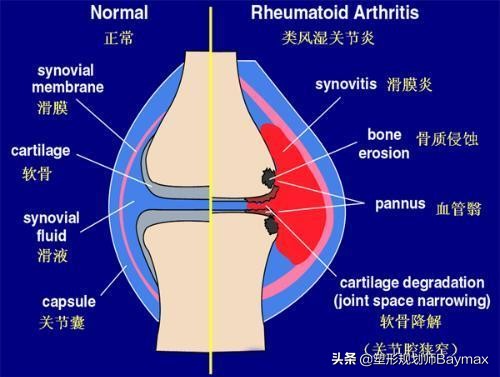 膝盖积水怎么办？不要只静养了，4个动作帮你有效缓解