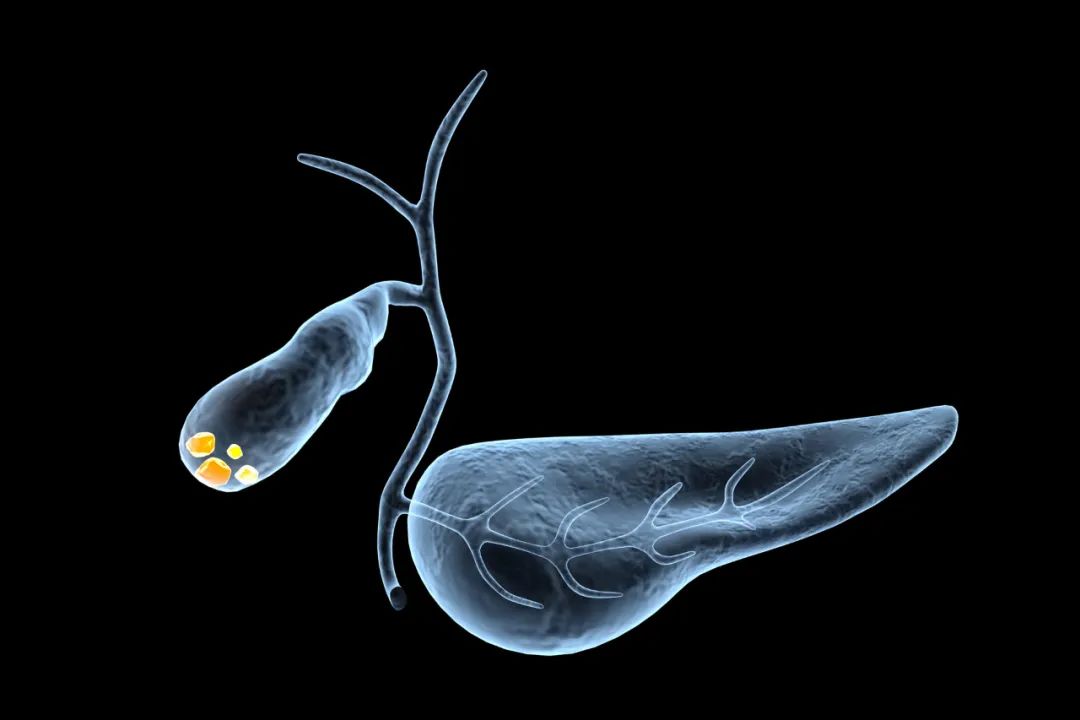 警惕：别成为胆结石“偏爱”的人