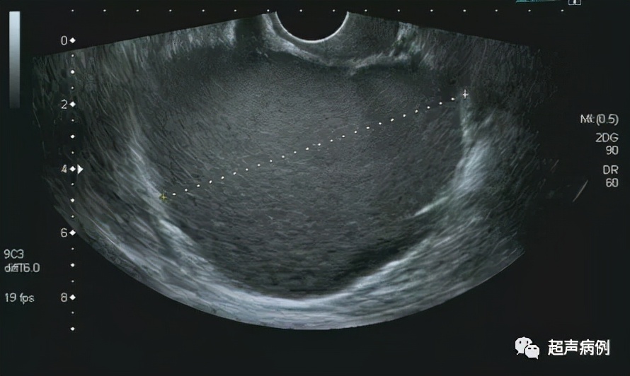 臀部疼痛就诊，超声意外发现这样盆腔包块
