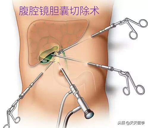 腹腔镜胆囊切除术后饮食护理问题,腹腔镜胆囊切除术后护理注意事项