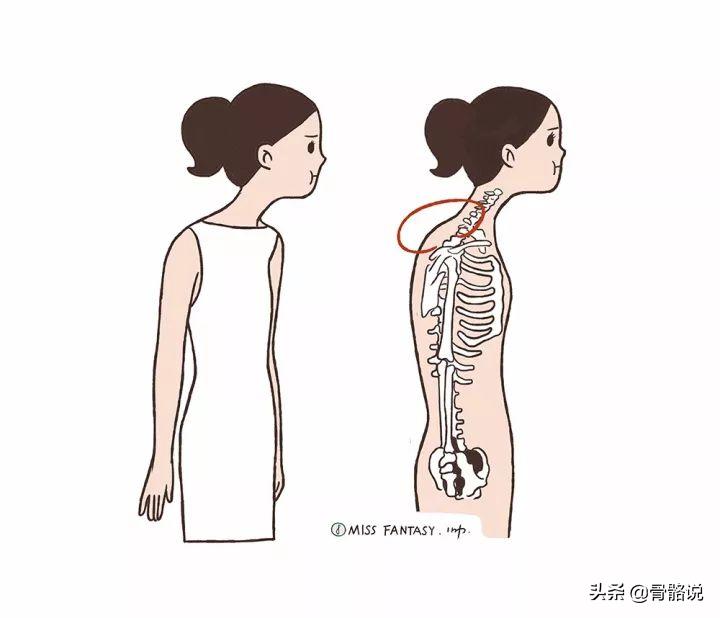 怎么预防脖子有个富贵包,脖子后的富贵包真是夺命包