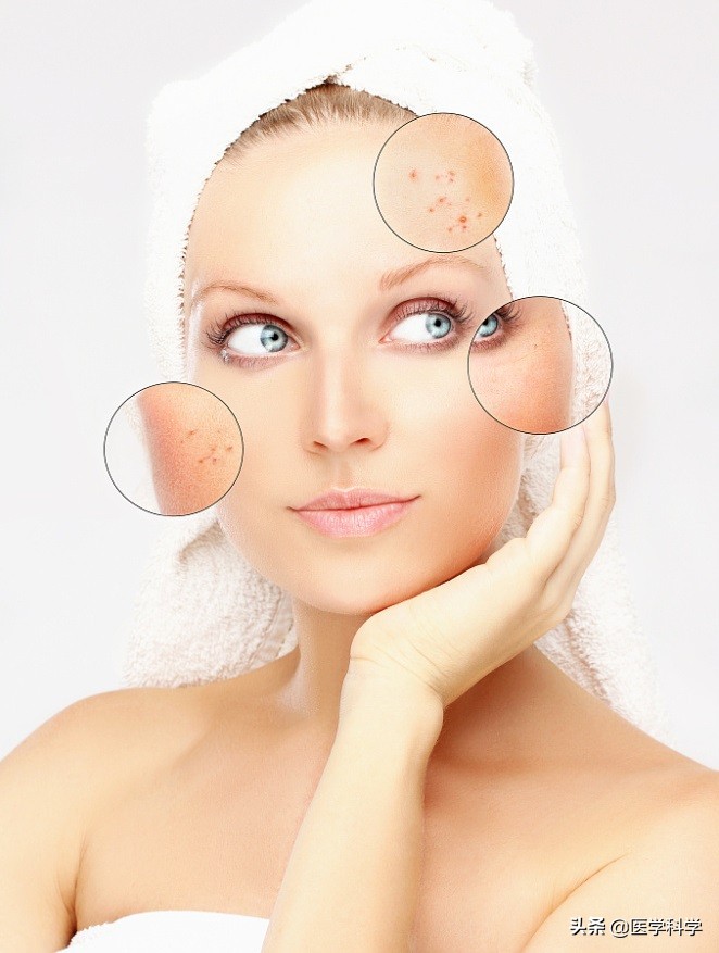 如何防止脸上长痘痘,为什么脸上老是长痘痘