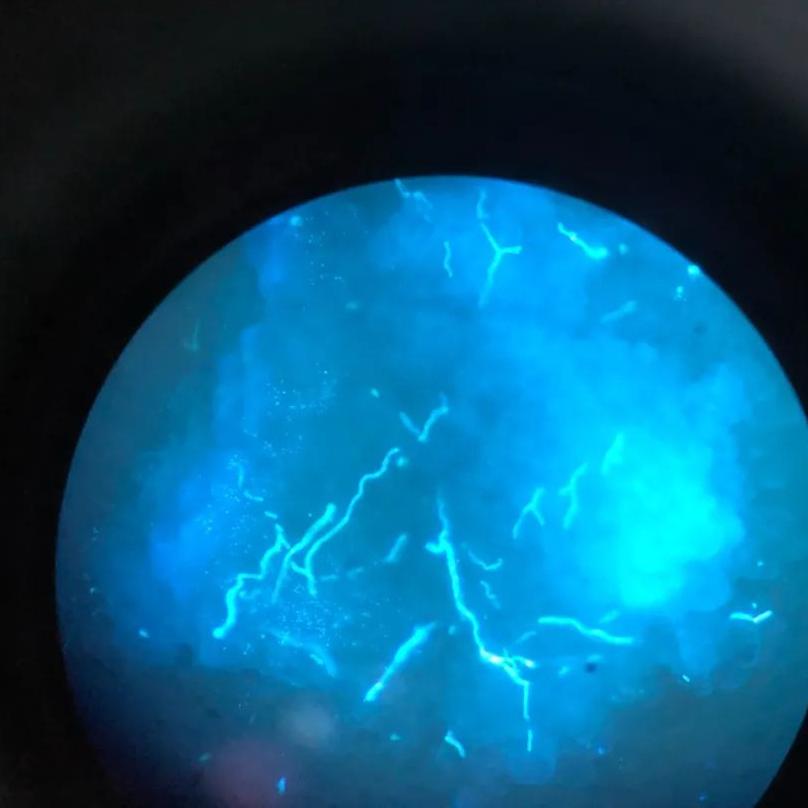 脚上干燥脱皮是真菌感染嘛,脚上因为真菌而开裂怎么办