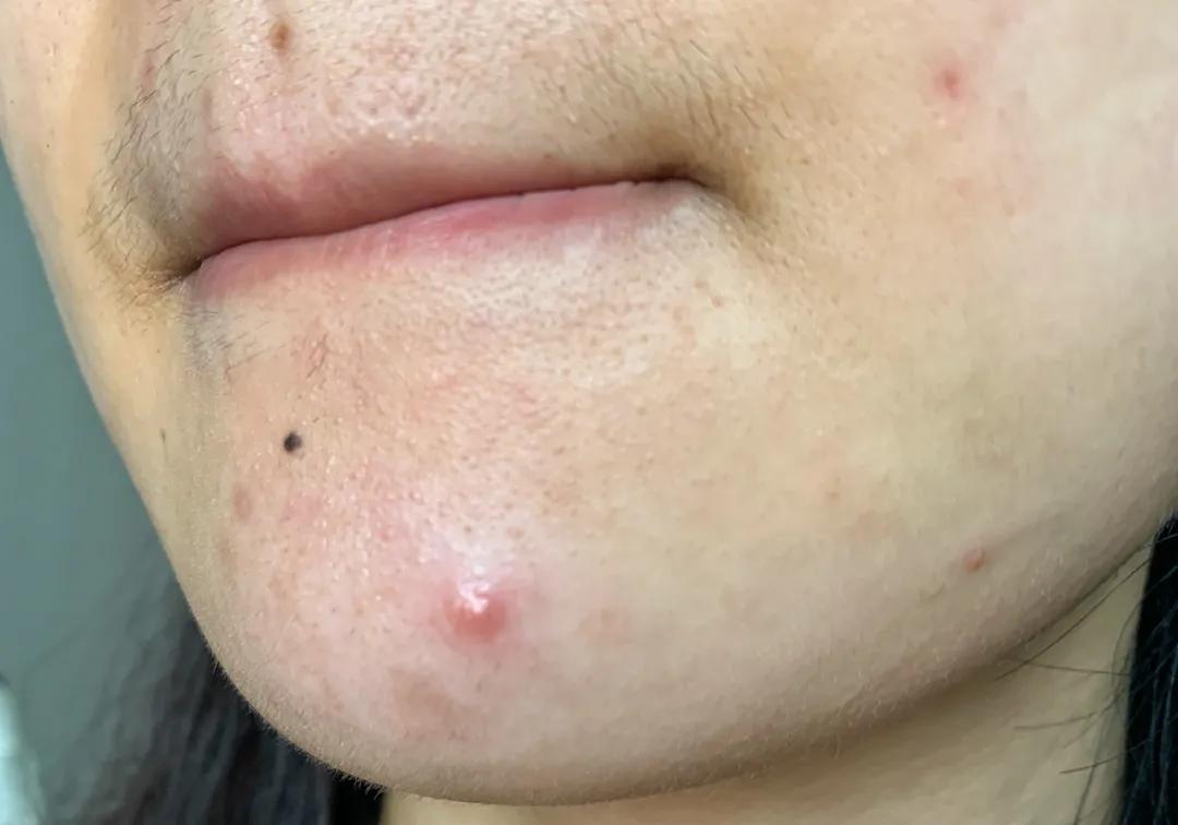 每到换季就会爆痘,换季时爆痘