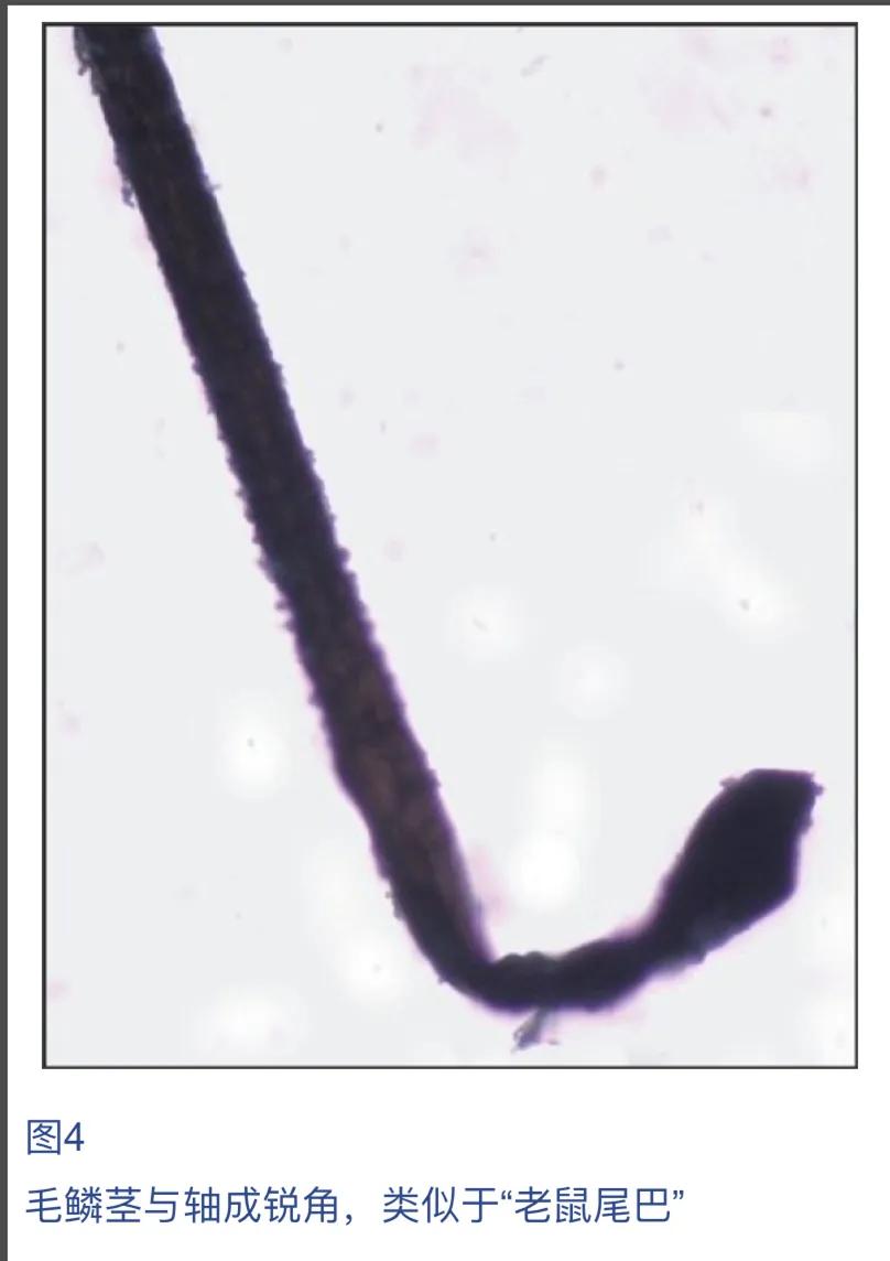 儿童脱发会是什么病的前兆,孩子毛囊引起的脱发怎么办