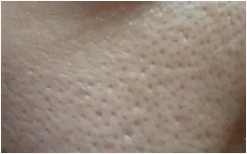 皮肤粗糙毛孔粗大最快的解决办法,皮肤松弛毛孔粗大黑头多怎么解决