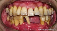 牙缝大是福是祸,牙缝宽什么命运