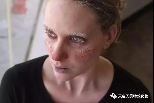 轻度冻伤怎么处理最佳方法,严重冻伤及时处理方法