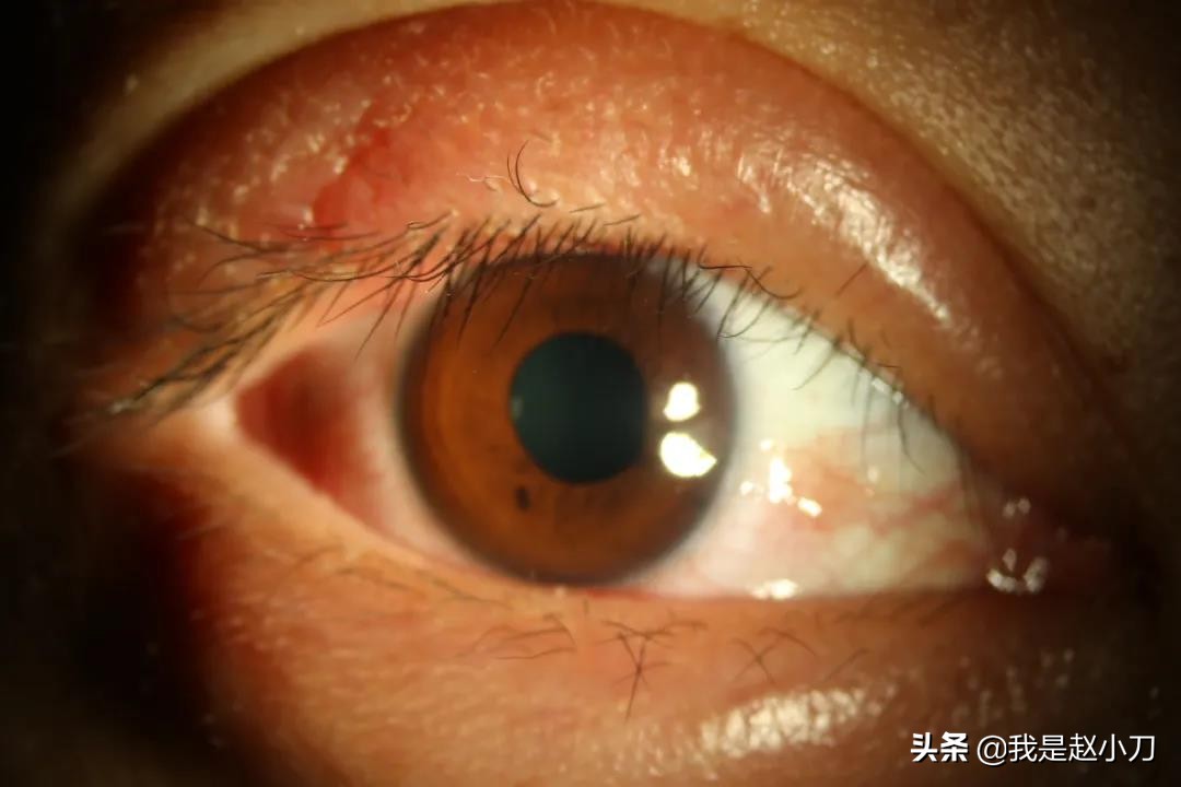 麦粒肿怎么治疗用什么眼药水治疗,麦粒肿可以用多久治愈