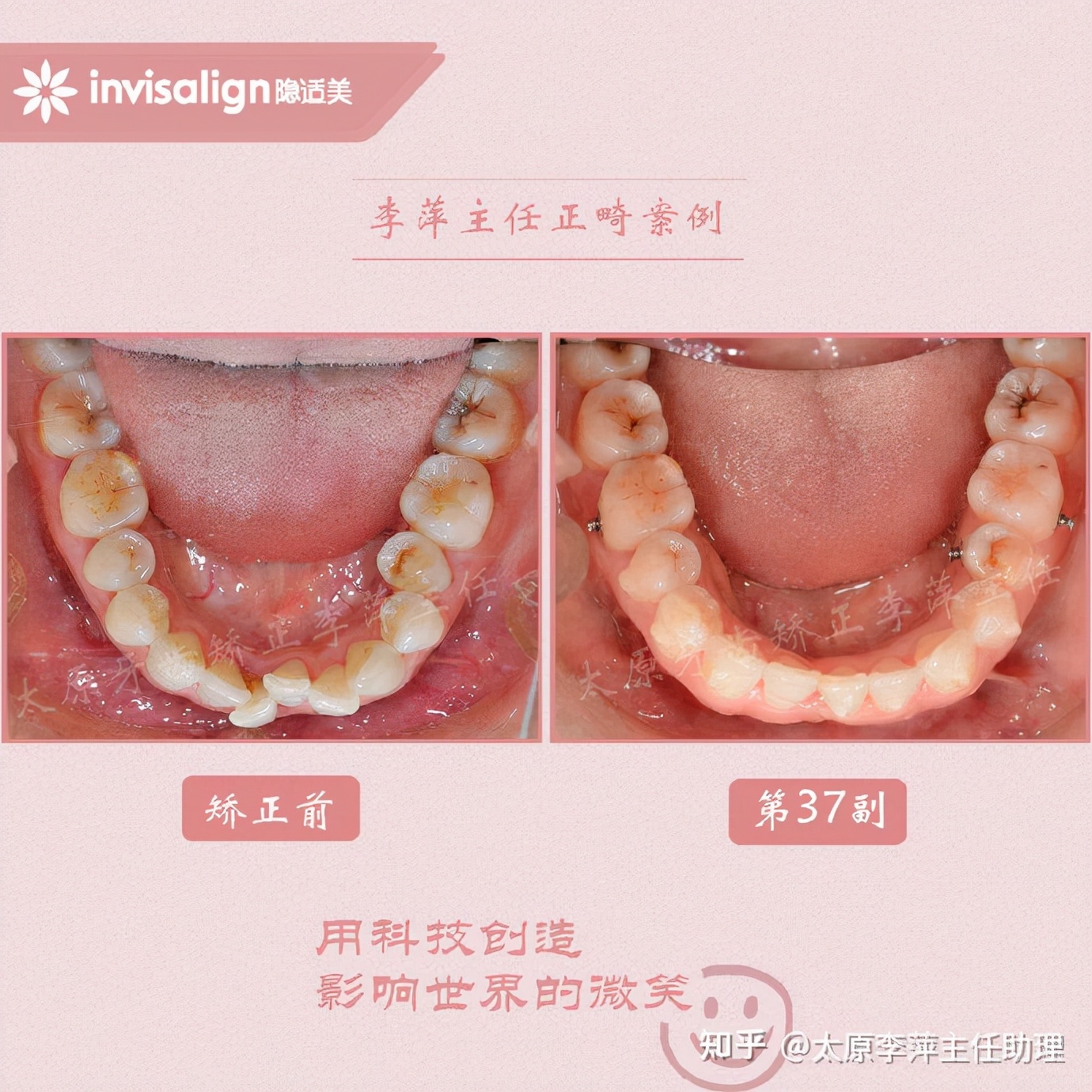重度拥挤矫正牙齿适合隐形牙套吗,广州成人牙齿矫正推荐隐形牙套